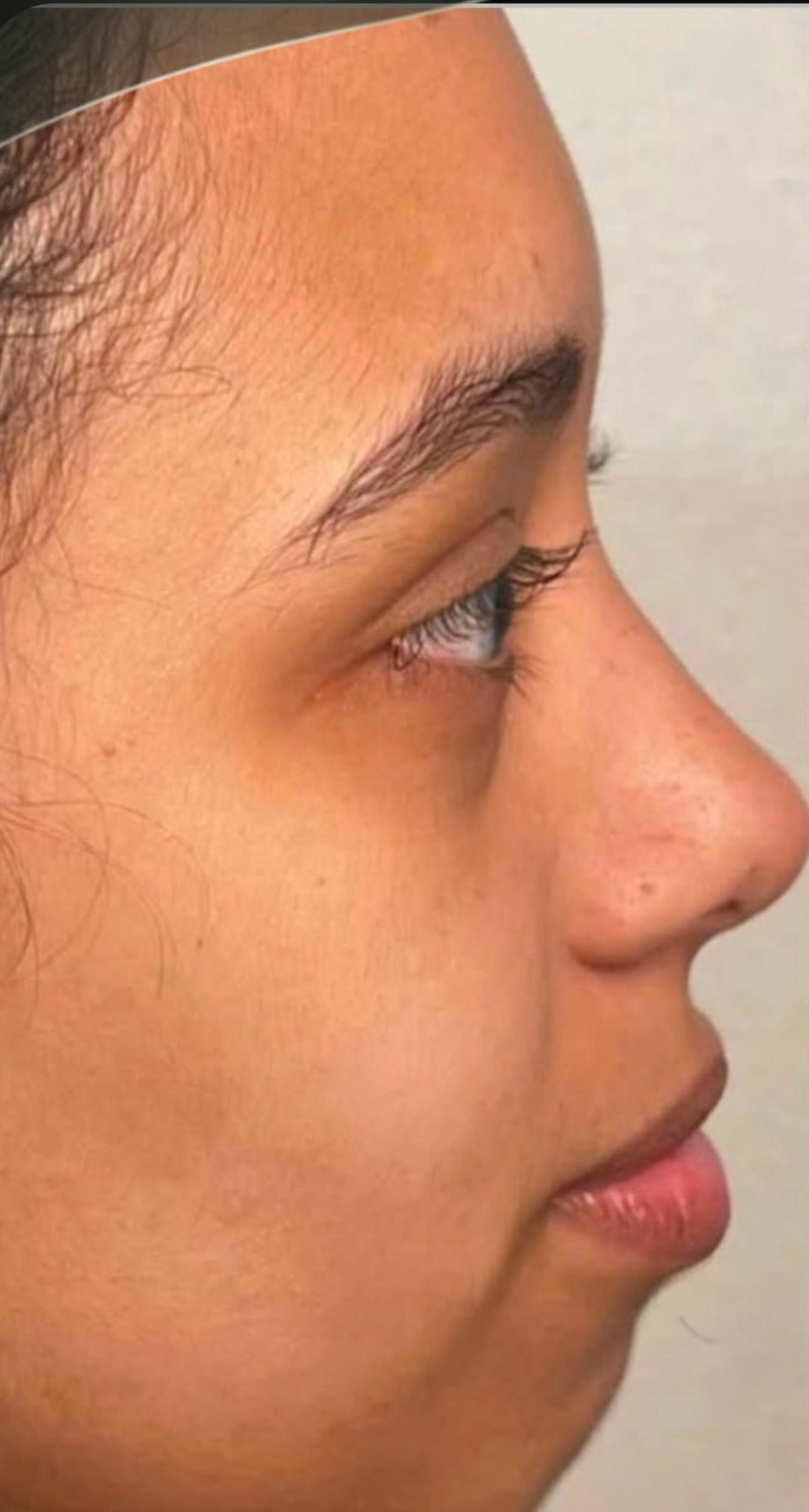 Antes do procedimento, caso de perfil e contorno